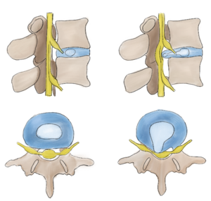 腰椎椎間板とヘルニアの状態を水平面と矢状面のイラスト